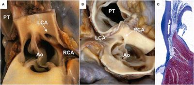 Sudden Death and Coronary Artery Anomalies